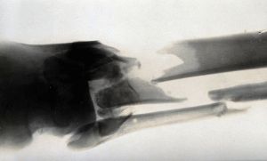 https://upload.wikimedia.org/wikipedia/commons/8/84/X-ray_of_a_broken_lower_leg_Wellcome_V0030072.jpg